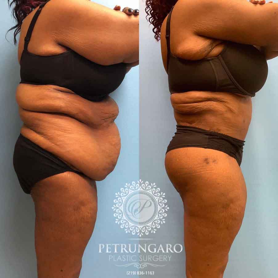 53-before-after-fleur-de-lis-body-lift-liposuction-brazilian-butt-lift-7
