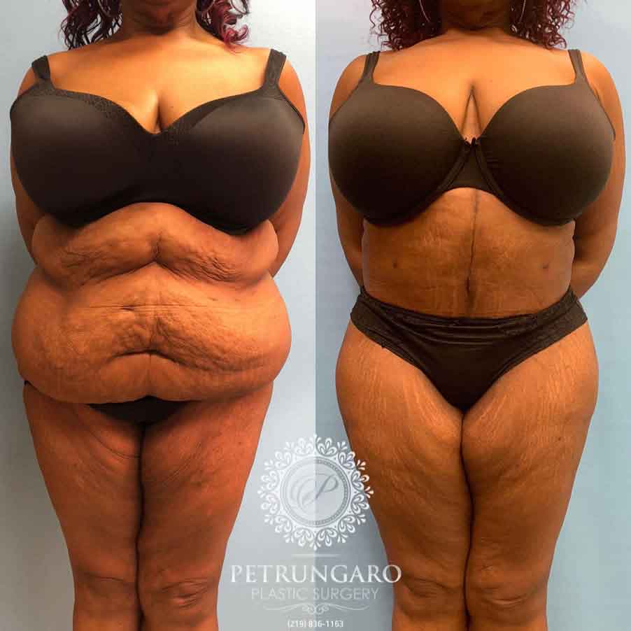 53-before-after-fleur-de-lis-body-lift-liposuction-brazilian-butt-lift-8