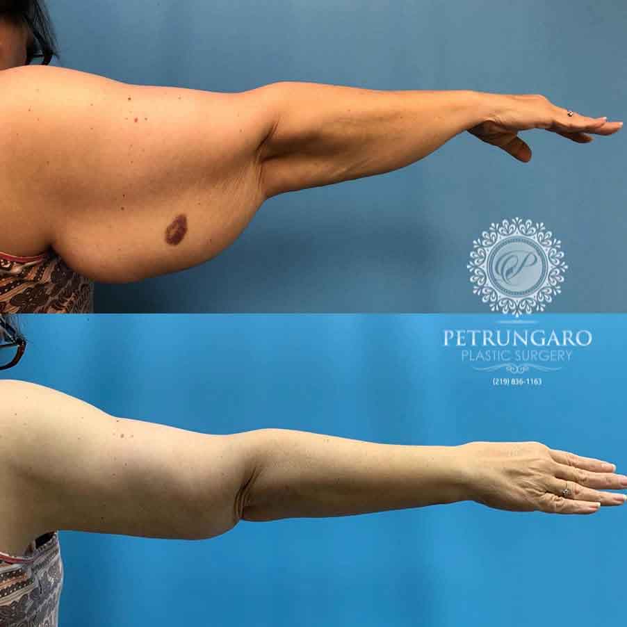 58-woman-before-after-armlift-3
