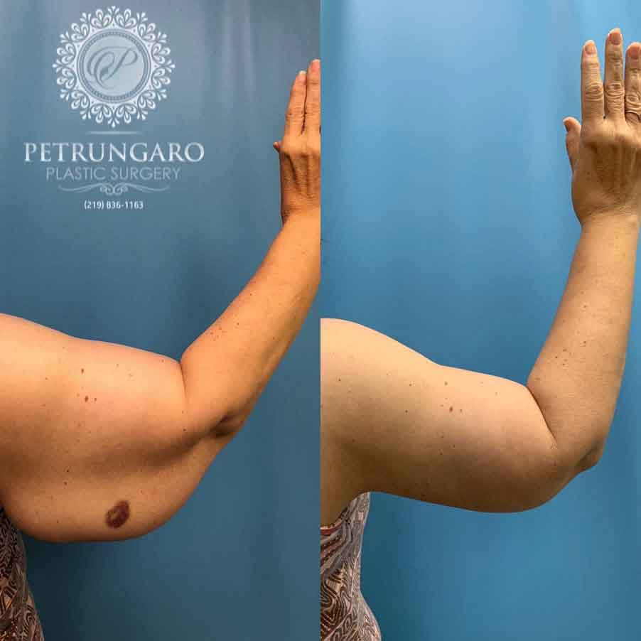 58-woman-before-after-armlift-5