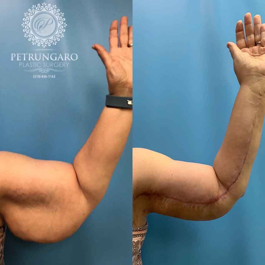 58-woman-before-after-armlift-7