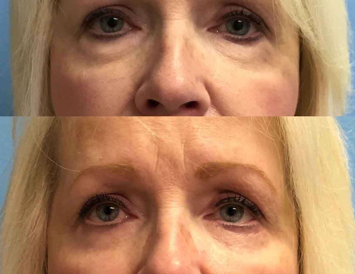 65-female-eyelid-surgery-1