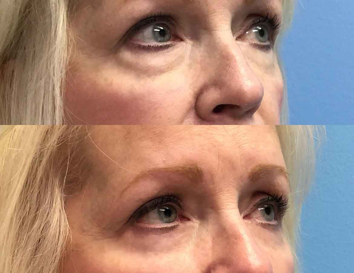 65-female-eyelid-surgery-2