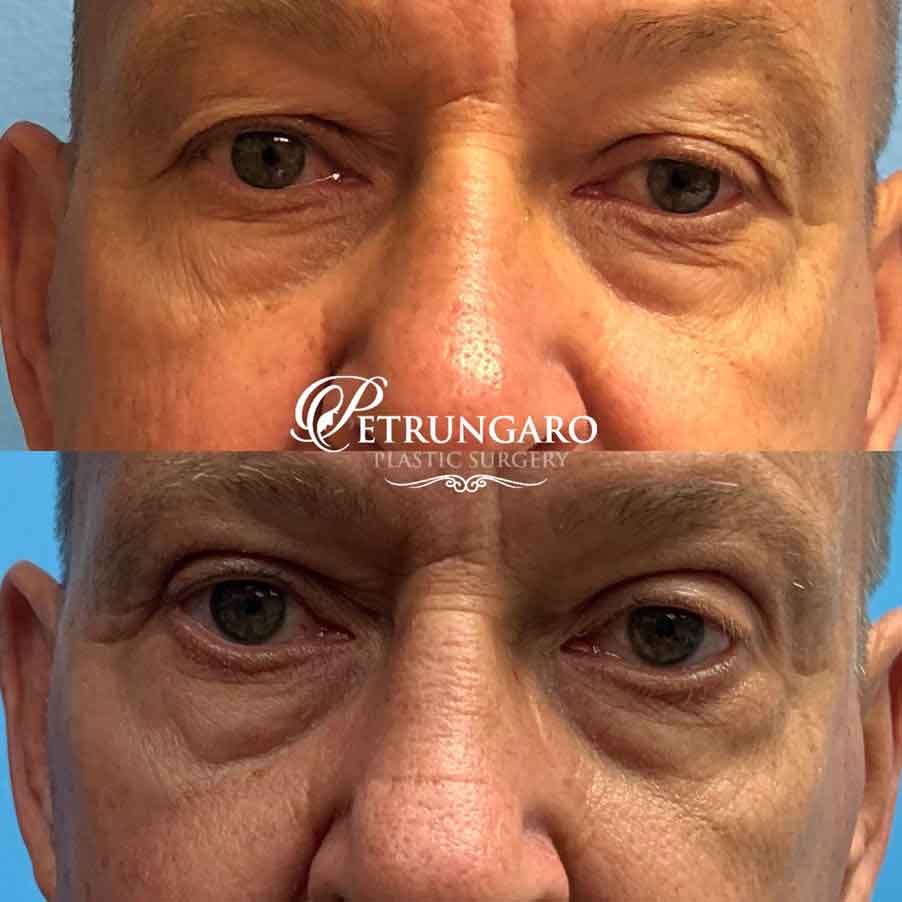 66-man-before-after-photo-upper-eyelid-lift-1