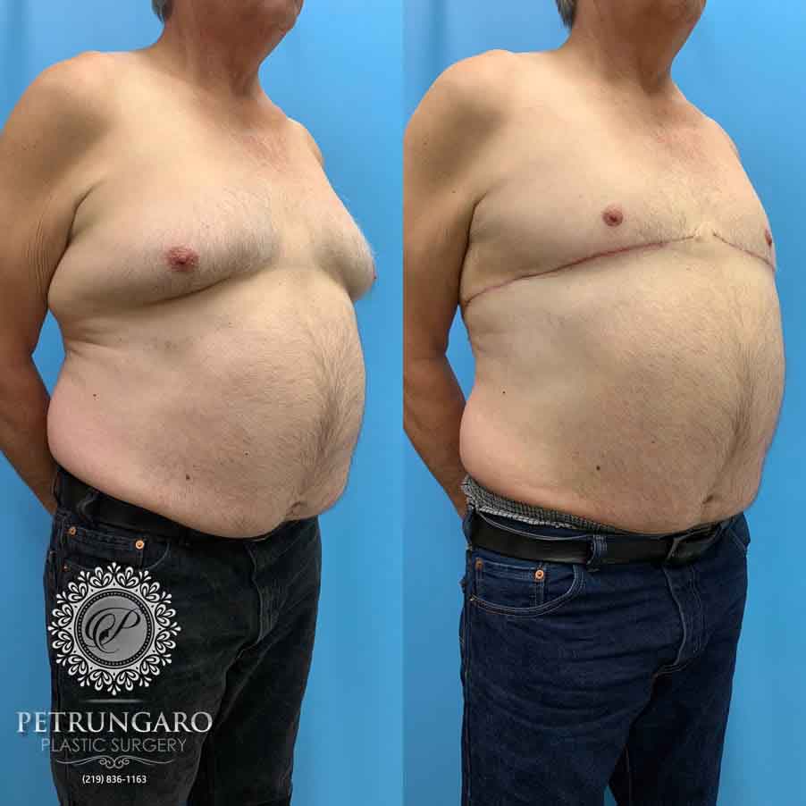 67-male-before-after-breast-surgery-2