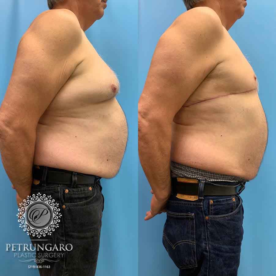 67-male-before-after-breast-surgery-3