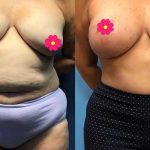 69-breast-augmentation-mommy-makeover-feature-newf