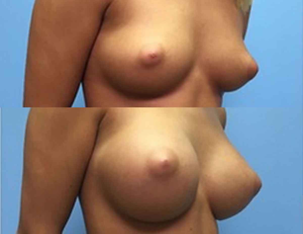 after-breast-augmentation-78