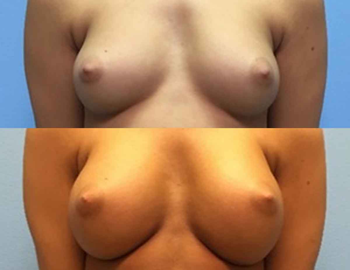 after-breast-augmentation-79