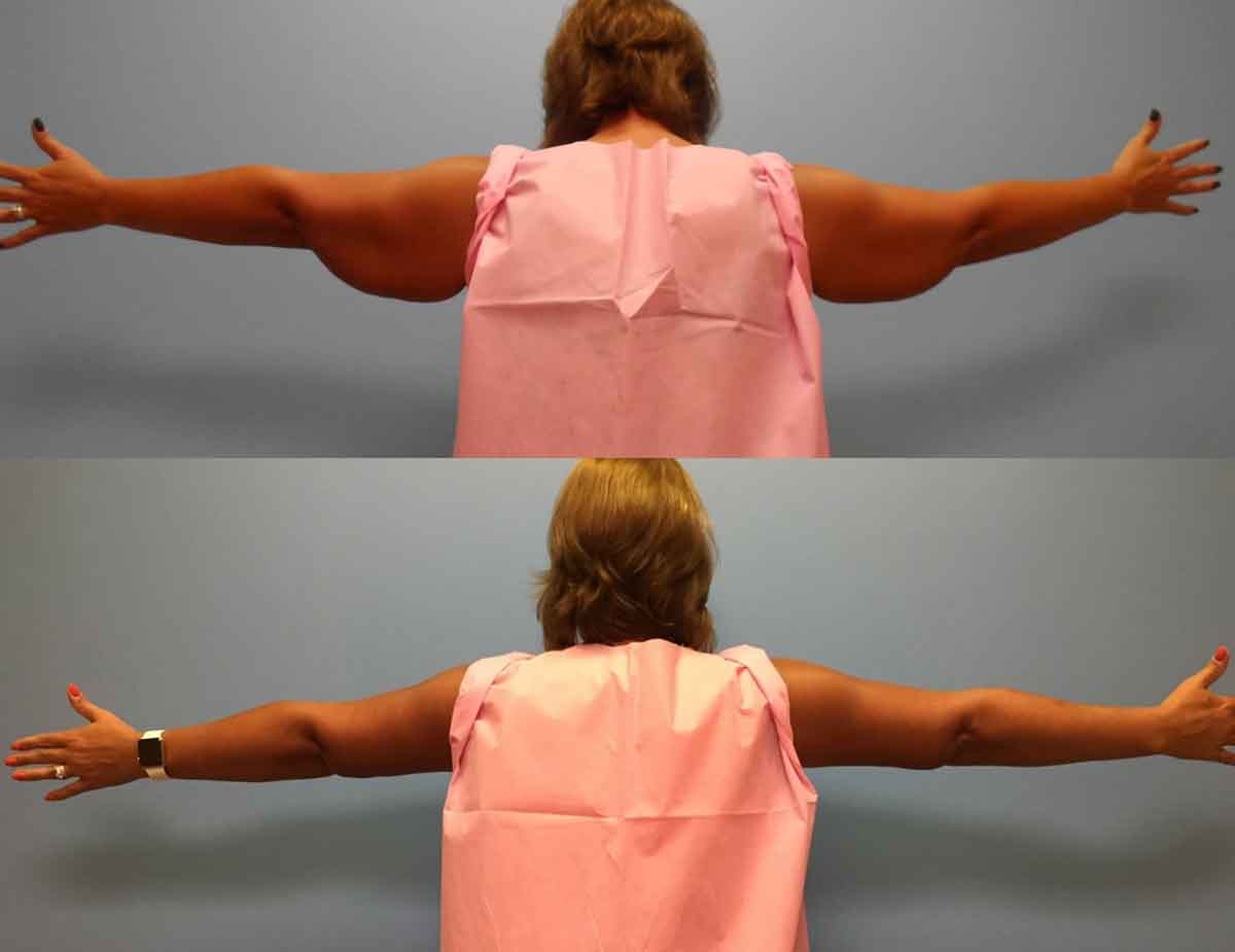 before-after-arm-lift-1a