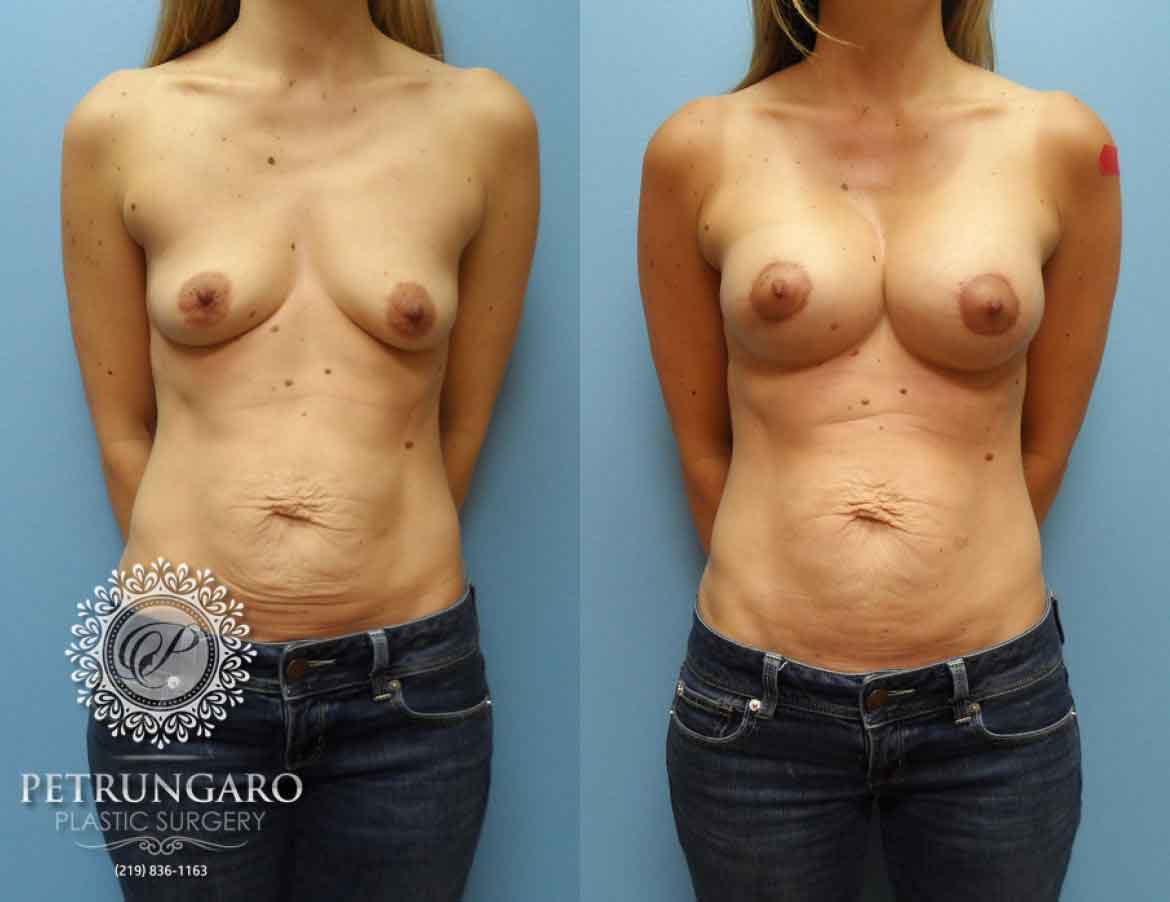 before-after-breast-implants-augmentation-lift-4a