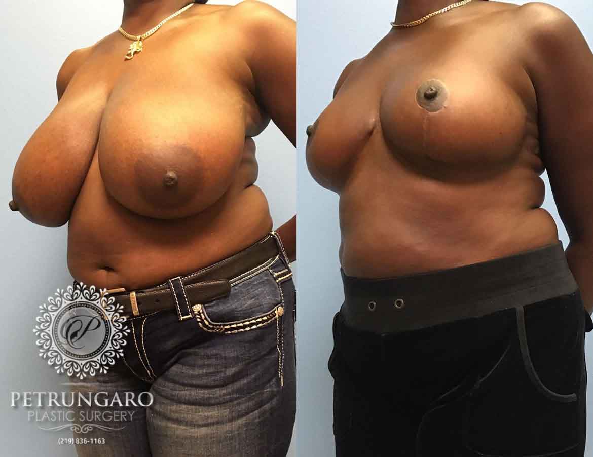 before-after-breast-reduction-1d