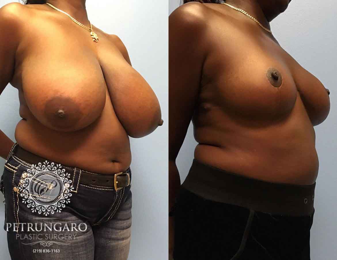 before-after-breast-reduction-1e