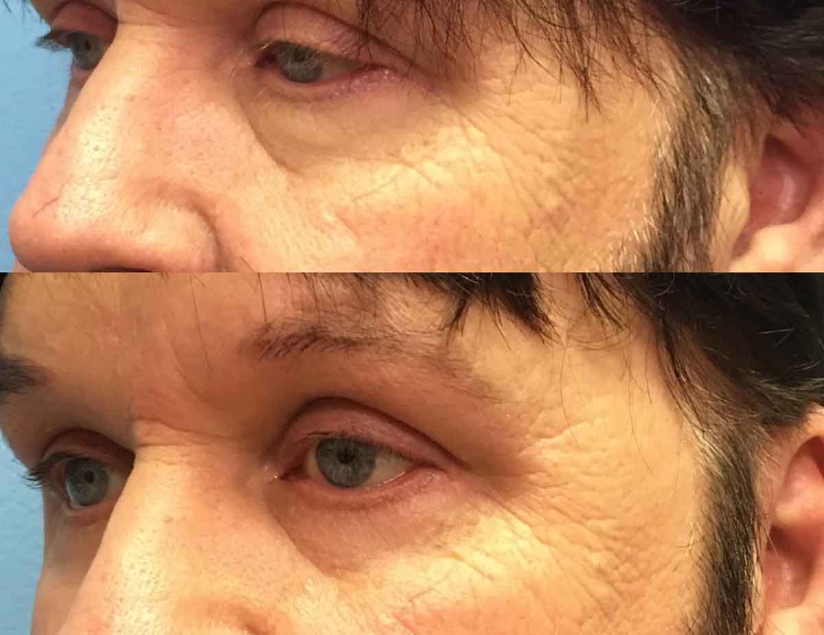 before-after-eyelid-surgery-2b