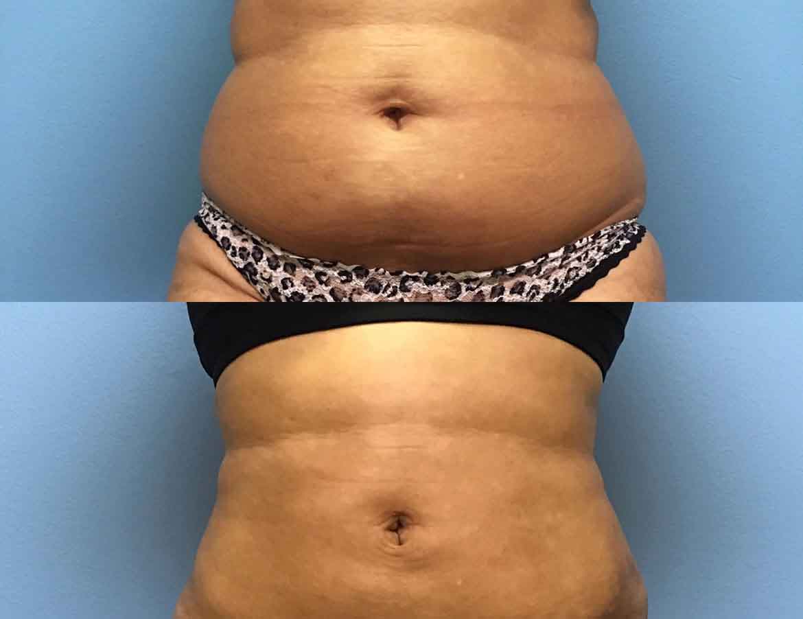 before-after-liposuction-1a