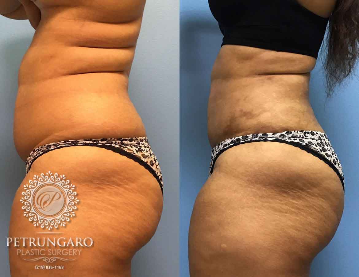 before-after-liposuction-1b