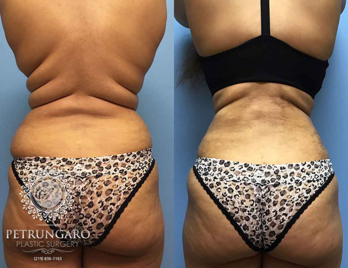 before-after-liposuction-1c