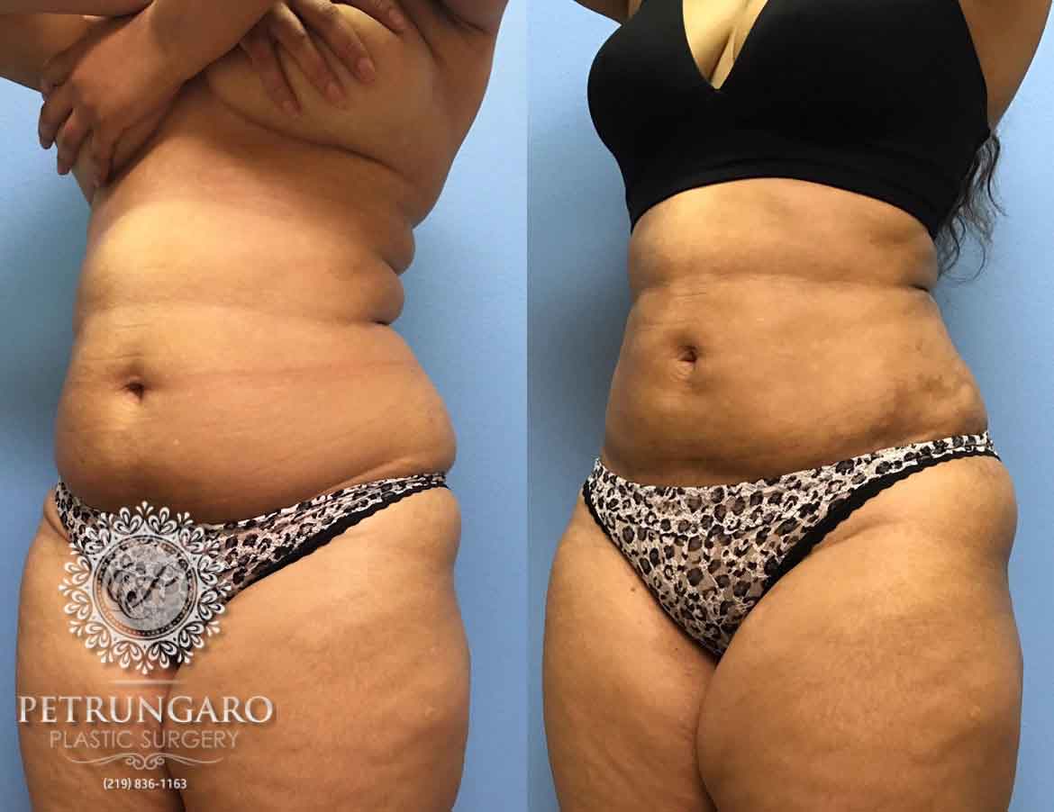 before-after-liposuction-1d