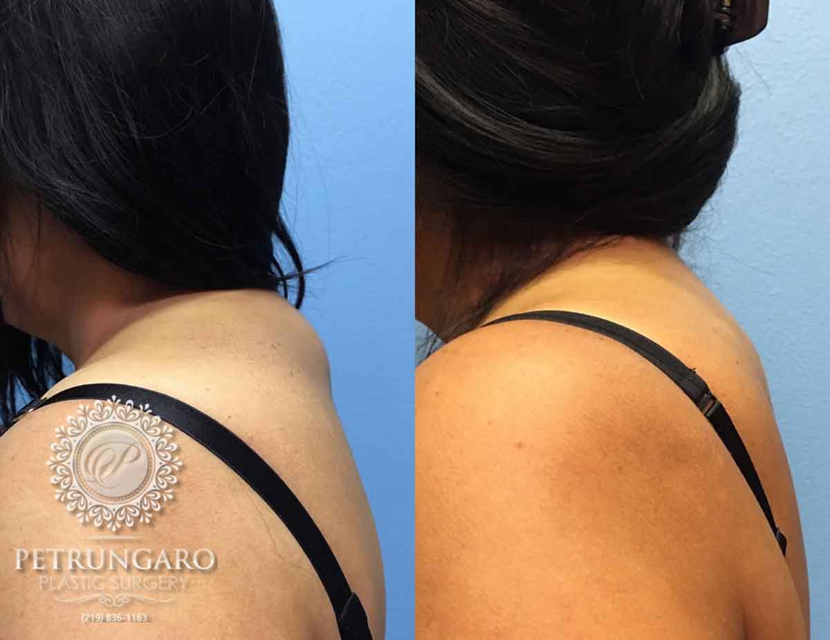 before-after-liposuction-upper-back-pad