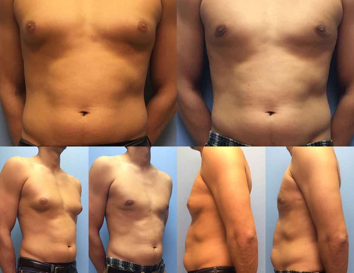 before-after-male-gynecomastia-1-1