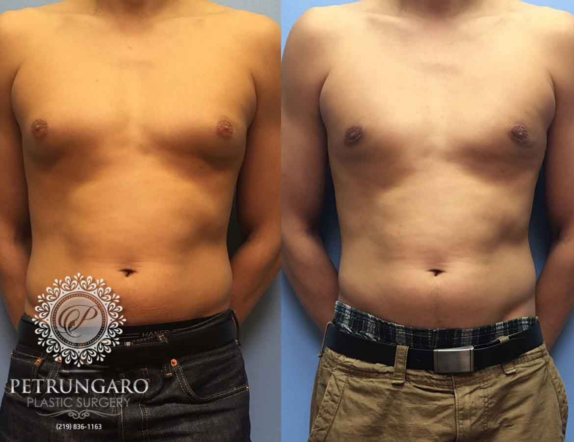 before-after-male-gynecomastia-1a