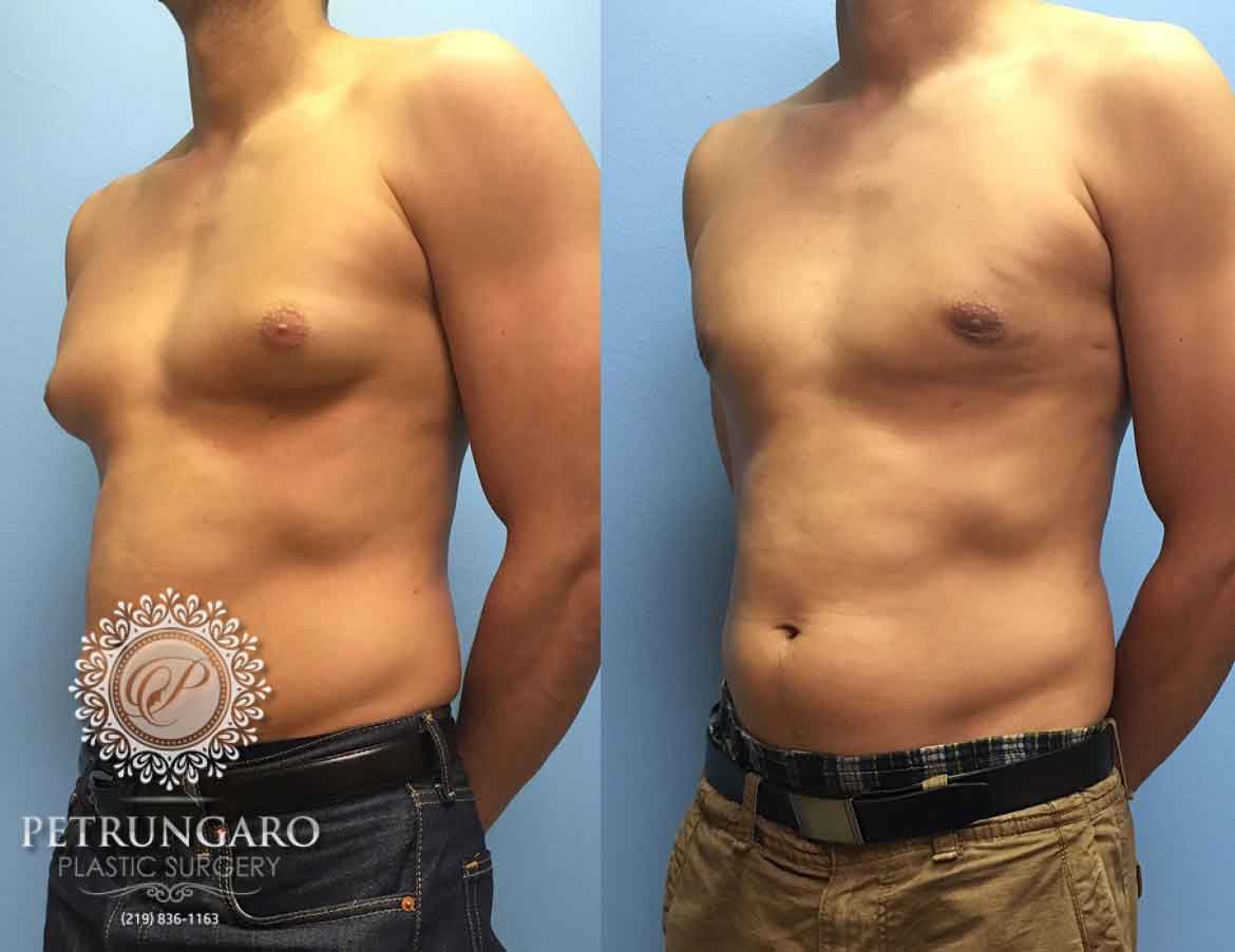 before-after-male-gynecomastia-1d