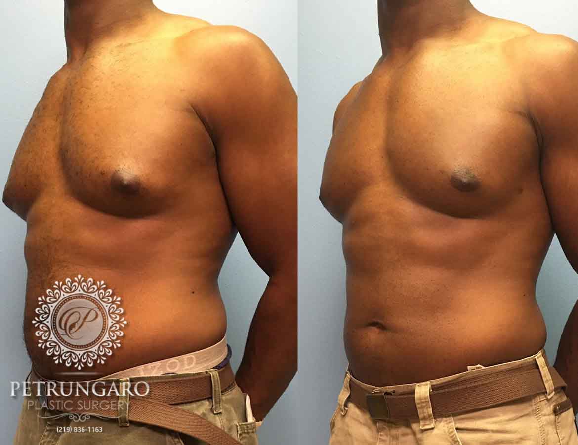 before-after-male-gynecomastia-2d