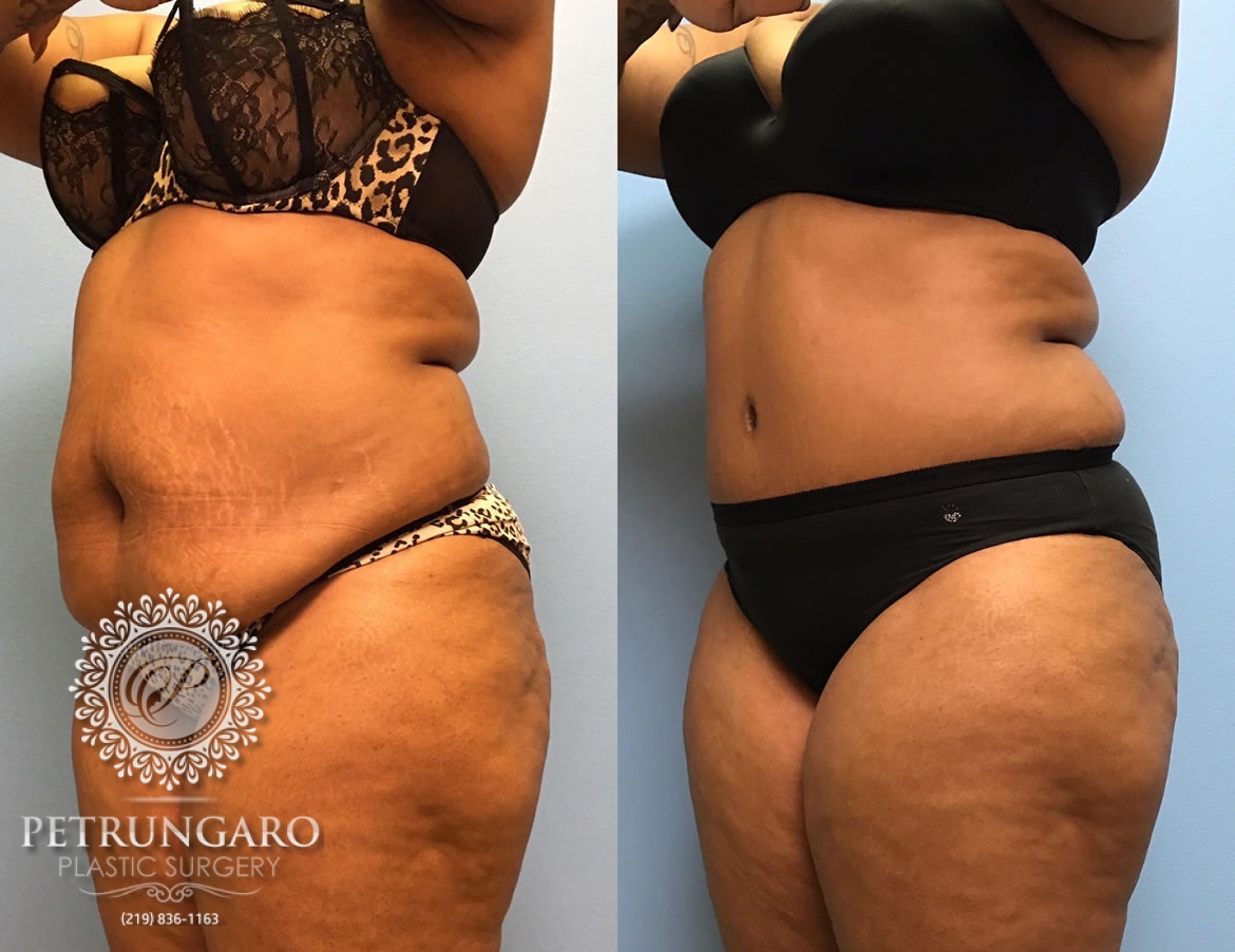 before-after-tummy-tuck-1a@2x