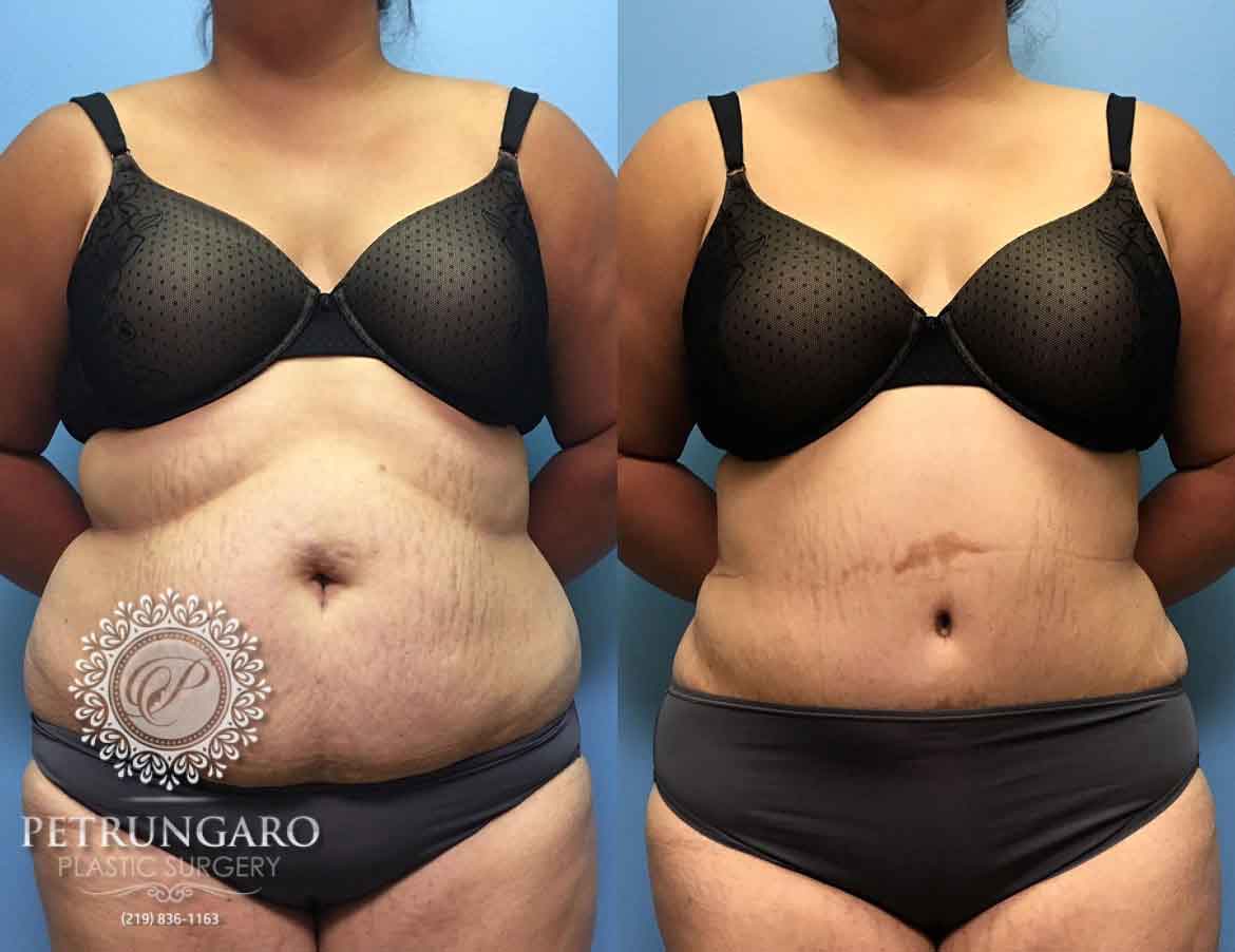 before-after-tummy-tuck-3a