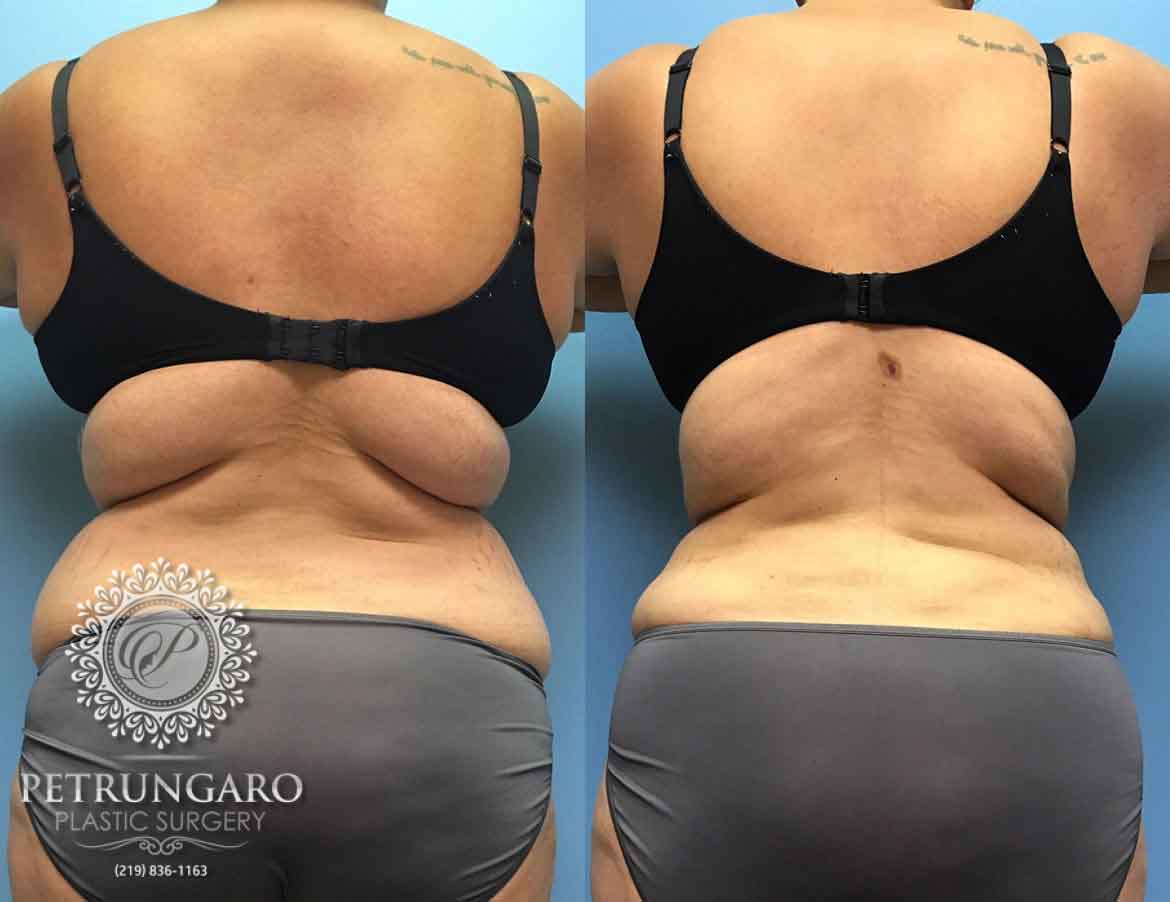 before-after-tummy-tuck-3b
