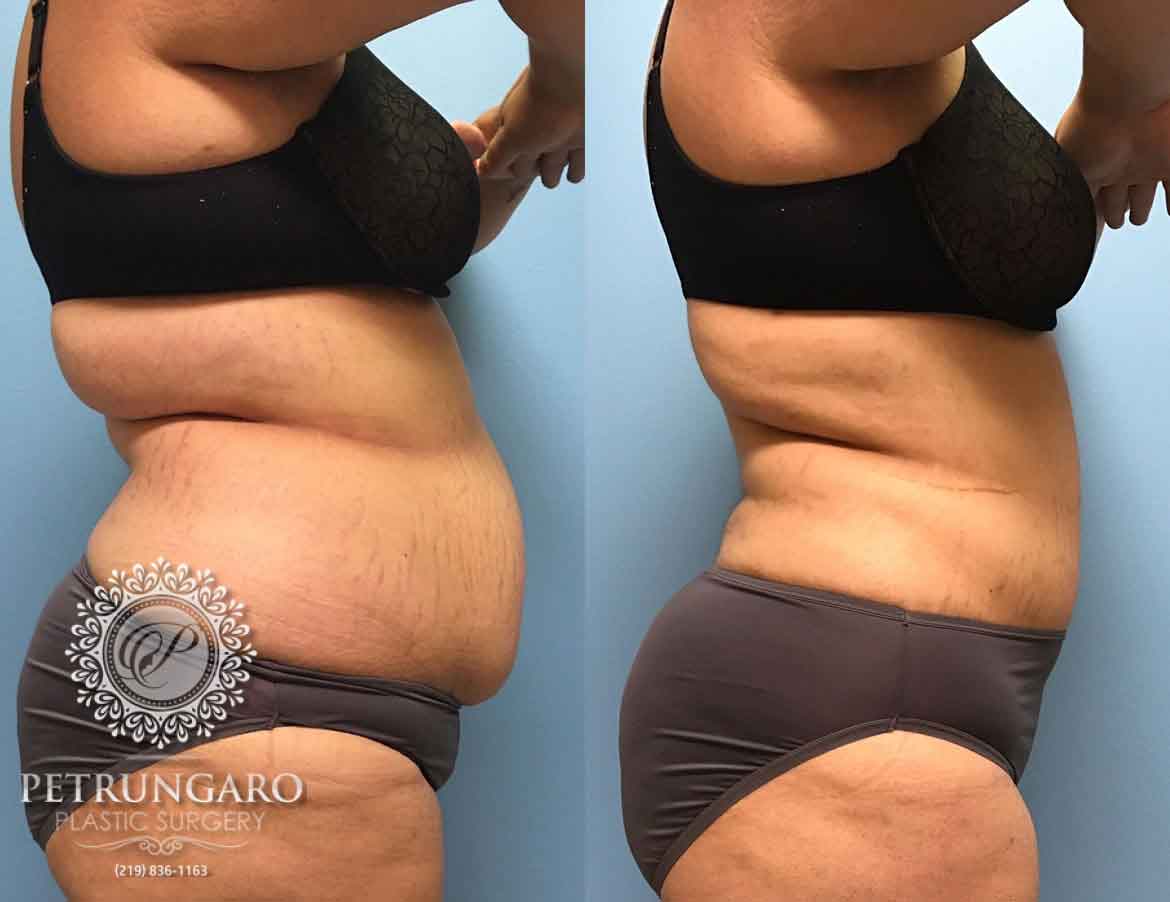 before-after-tummy-tuck-3c