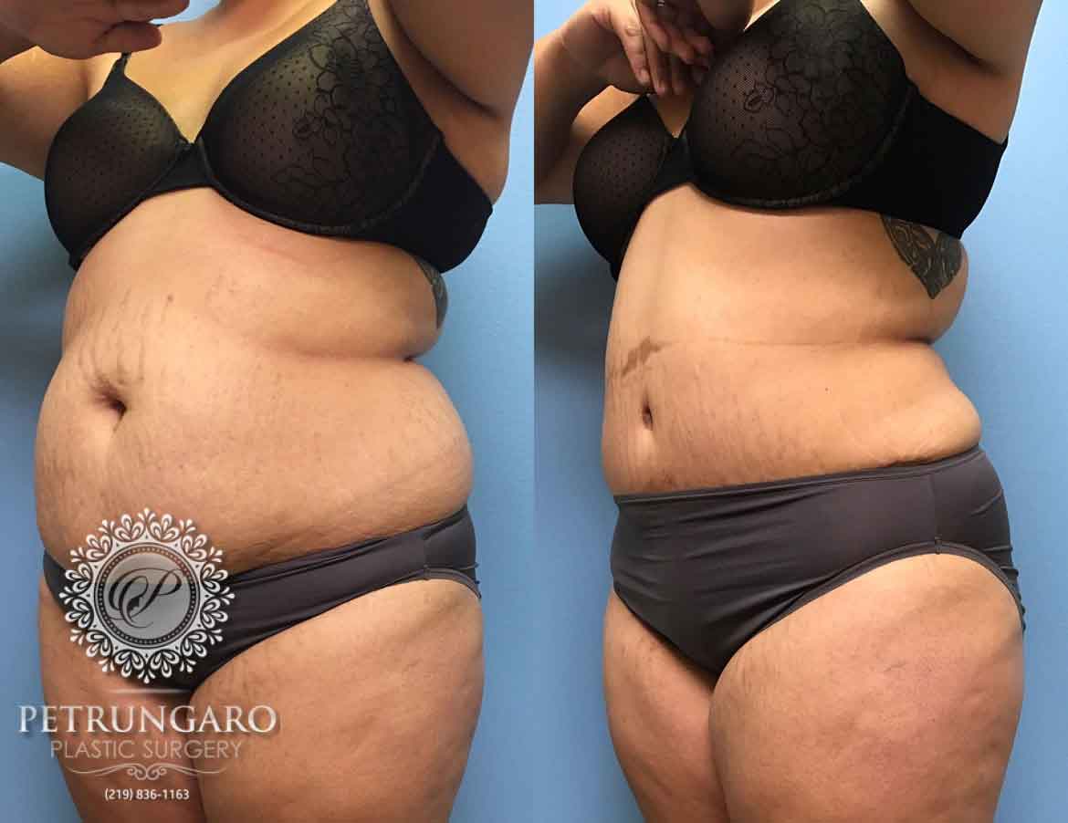 before-after-tummy-tuck-3e