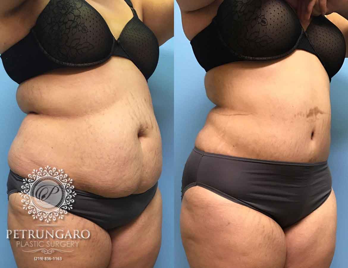 before-after-tummy-tuck-3f