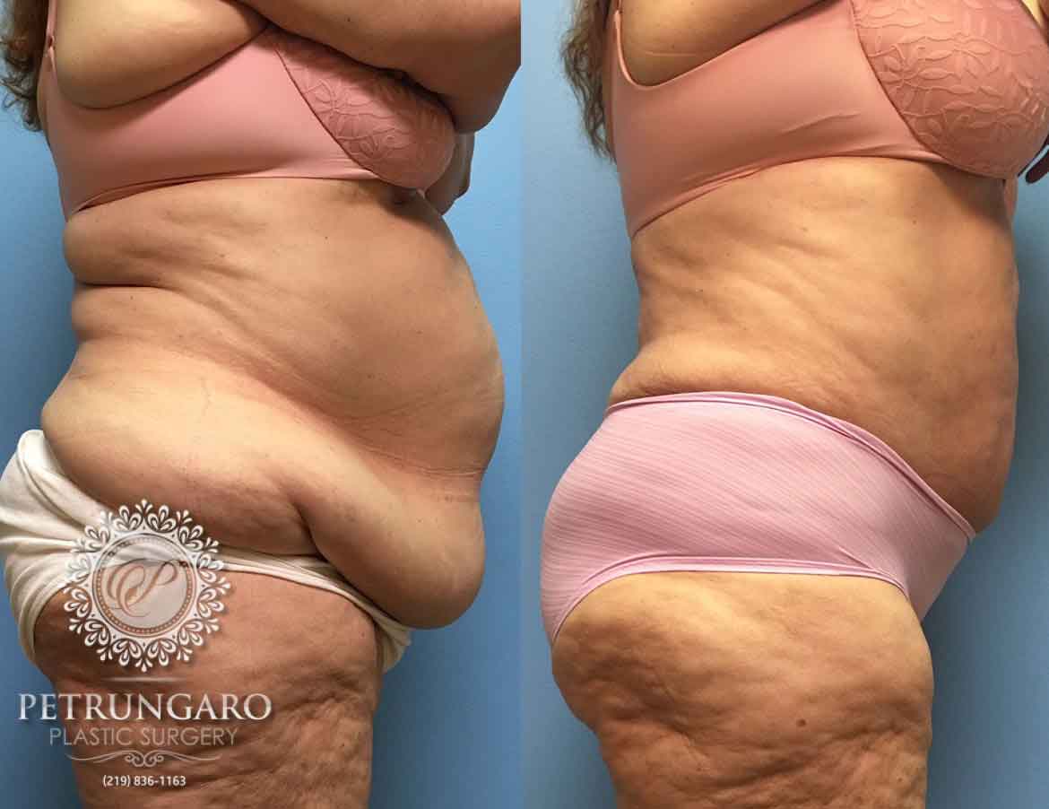 before-after-tummy-tuck-with-liposuction-5b
