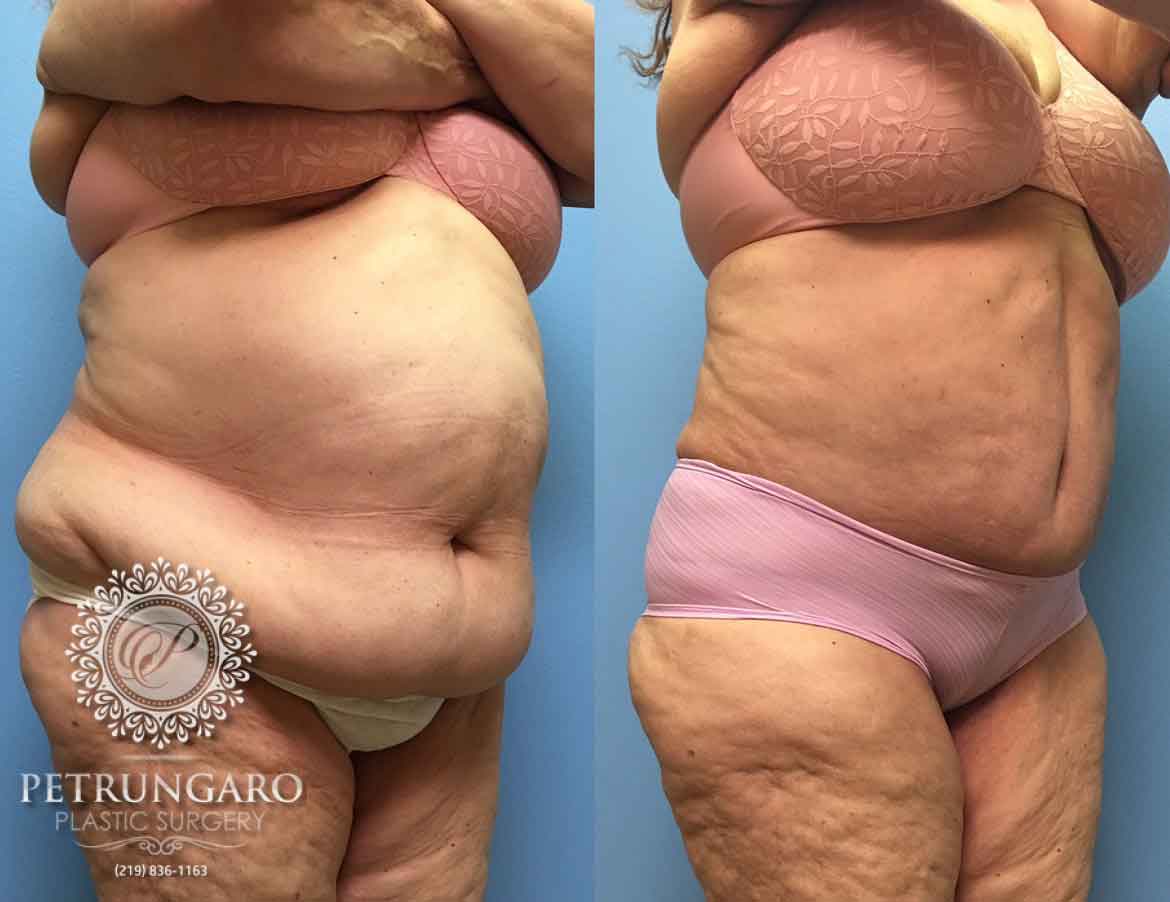 before-after-tummy-tuck-with-liposuction-5c