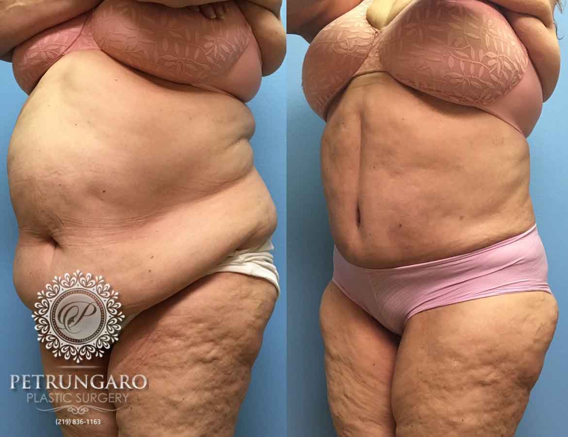 before-after-tummy-tuck-with-liposuction-5d