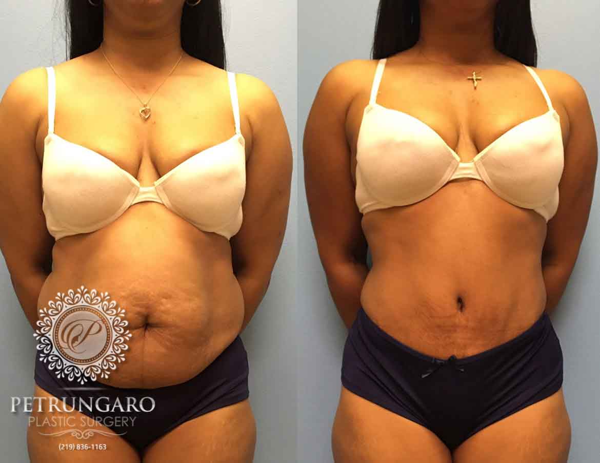 before-after-tummy-tuck-with-liposuction-6a