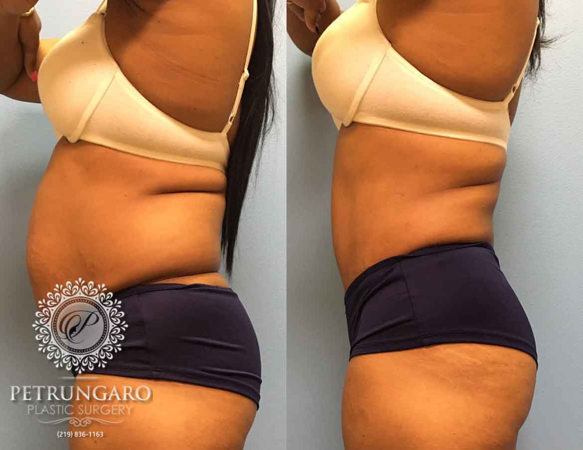 before-after-tummy-tuck-with-liposuction-6b