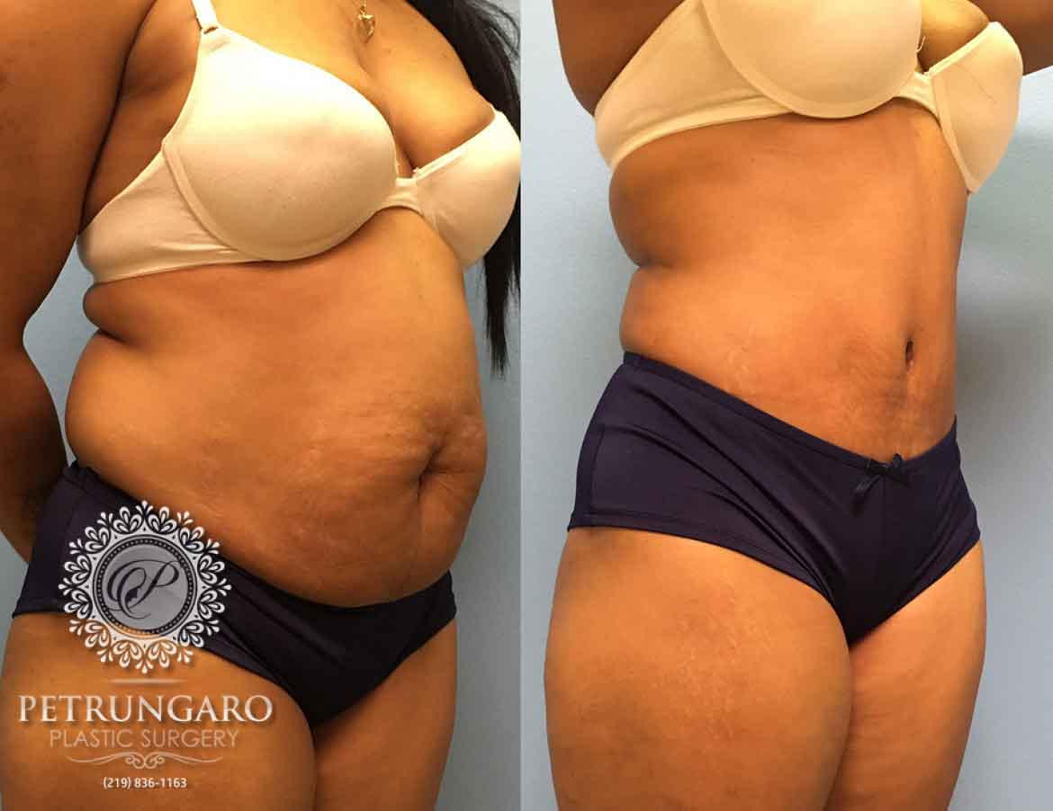 before-after-tummy-tuck-with-liposuction-6c