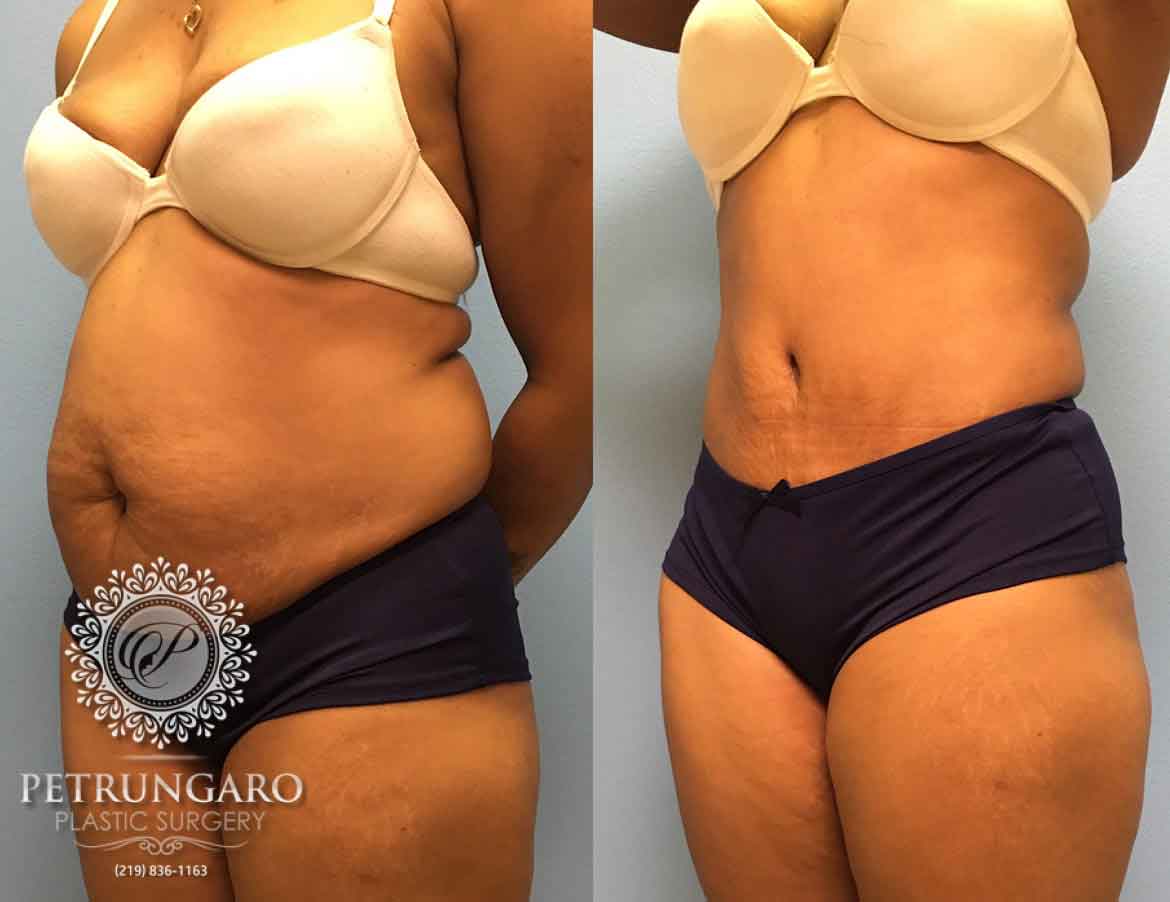 before-after-tummy-tuck-with-liposuction-6d