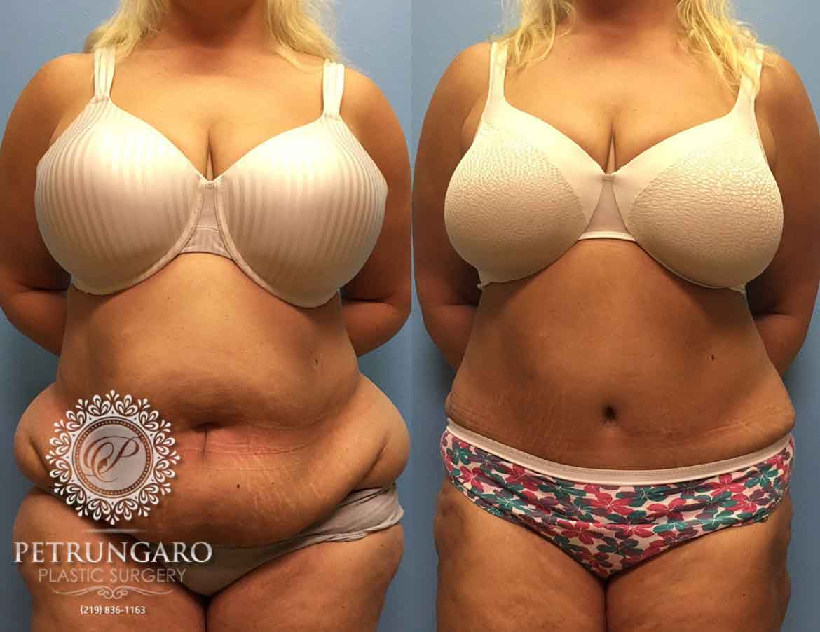 before-after-tummy-tuck-with-liposuction-7a-1