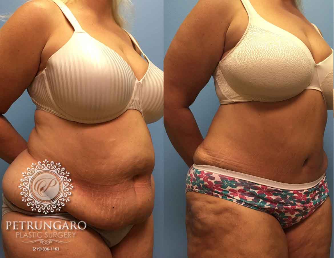 before-after-tummy-tuck-with-liposuction-7c