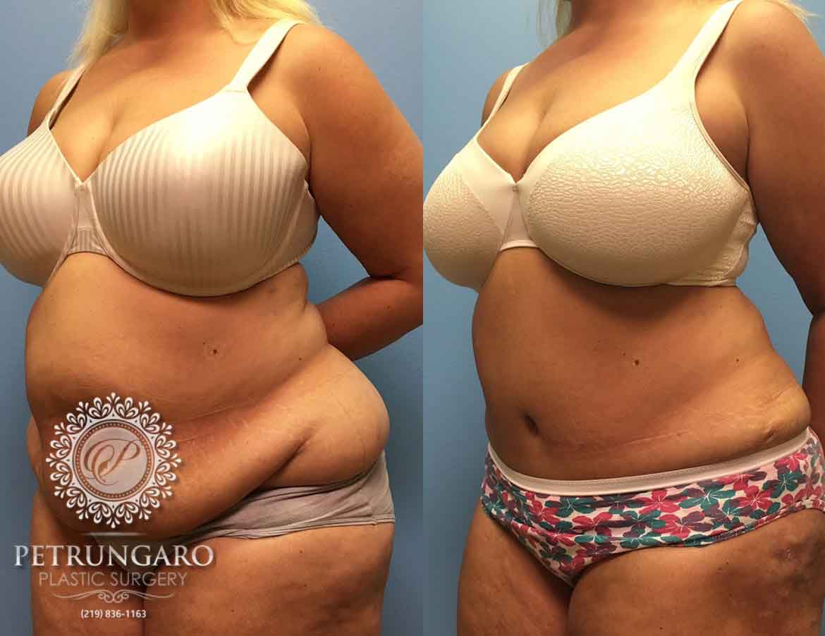 before-after-tummy-tuck-with-liposuction-7d