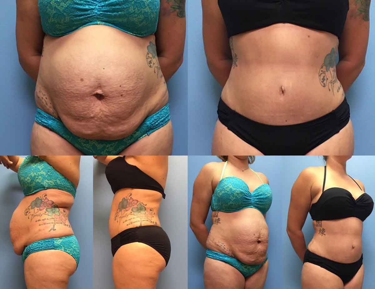 before-after-tummy-tuck-with-liposuction-8