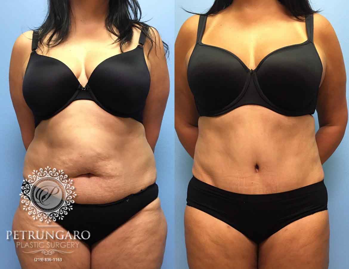51 F After Tummy Tuck With Lipo 360 Petrungaro Plastic Surgery.