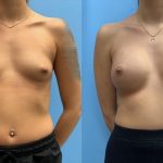 23-before-after-breast-augmentation-implants-featured
