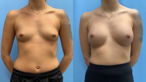 23-before-after-breast-augmentation-implants-featured