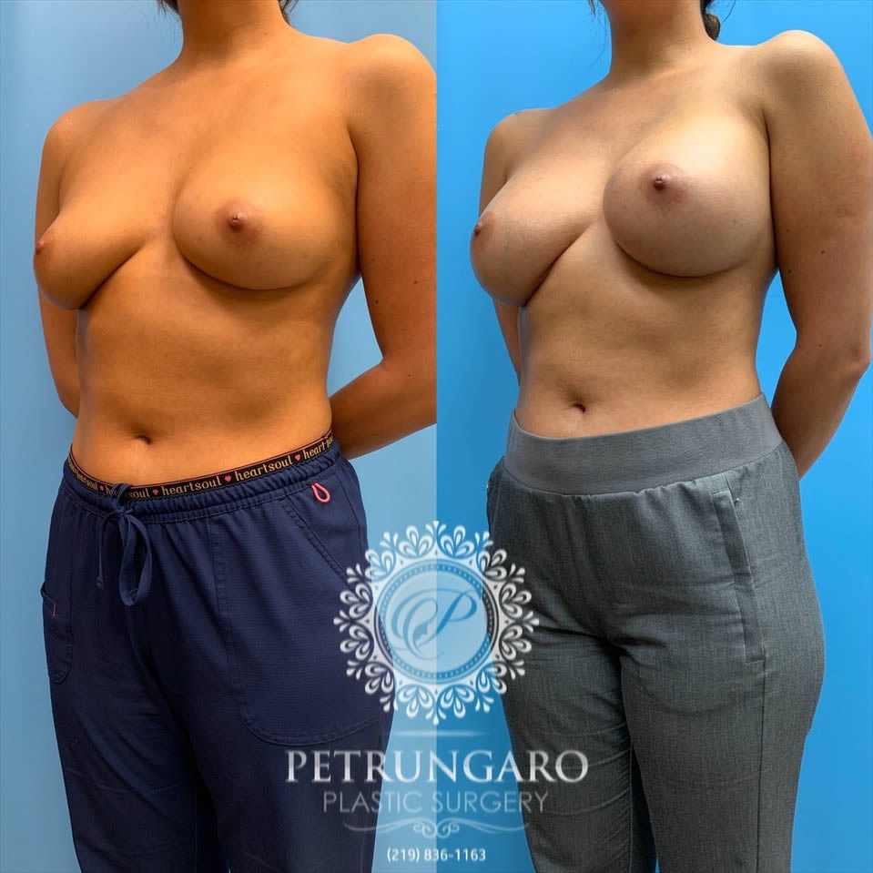27-before-after-breast-augmentation-implants-1