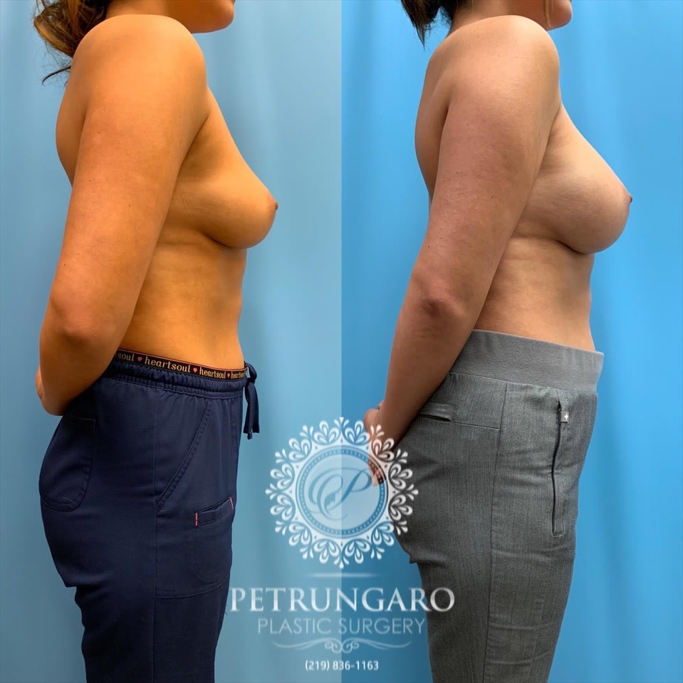 27-before-after-breast-augmentation-implants-3