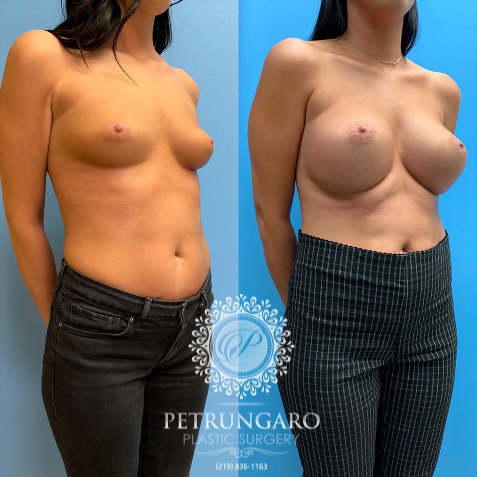 27-before-after-breast-implants-1